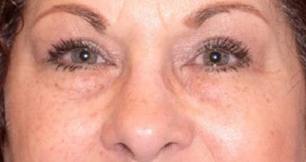  Blepharoplasty Before & After Gallery - Patient 25274650 - Image 2