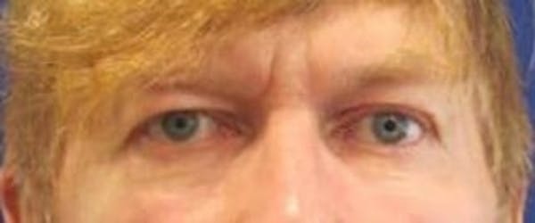  Blepharoplasty Before & After Gallery - Patient 25274652 - Image 1