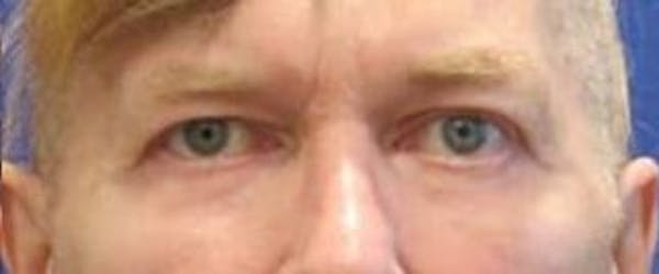  Blepharoplasty Before & After Gallery - Patient 25274652 - Image 2