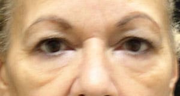  Blepharoplasty Before & After Gallery - Patient 25274654 - Image 1