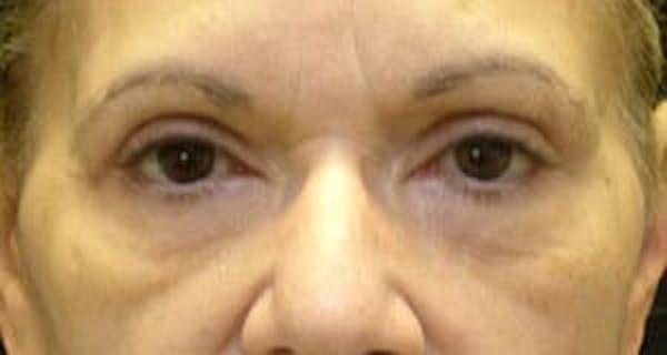  Blepharoplasty Before & After Gallery - Patient 25274654 - Image 2
