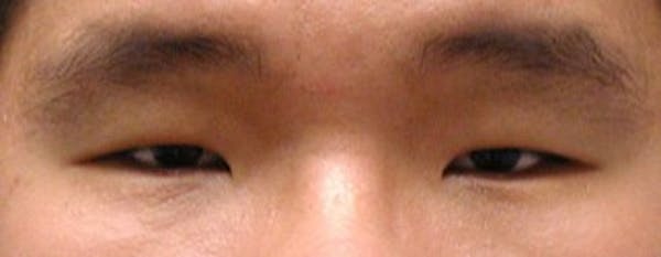  Blepharoplasty Before & After Gallery - Patient 25274656 - Image 1
