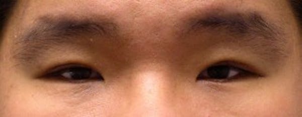  Blepharoplasty Before & After Gallery - Patient 25274656 - Image 2