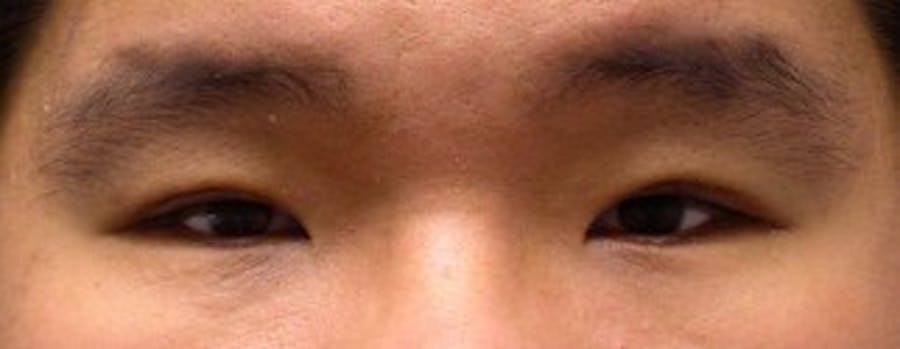 Blepharoplasty Before & After Gallery - Patient 25274656 - Image 2