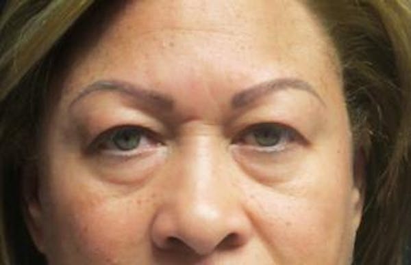  Blepharoplasty Before & After Gallery - Patient 25274657 - Image 1