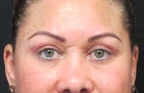  Blepharoplasty Before & After Gallery - Patient 25274657 - Image 2