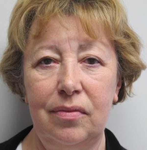  Blepharoplasty Before & After Gallery - Patient 25274658 - Image 1