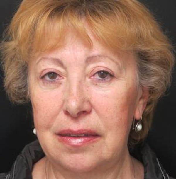  Blepharoplasty Before & After Gallery - Patient 25274658 - Image 2