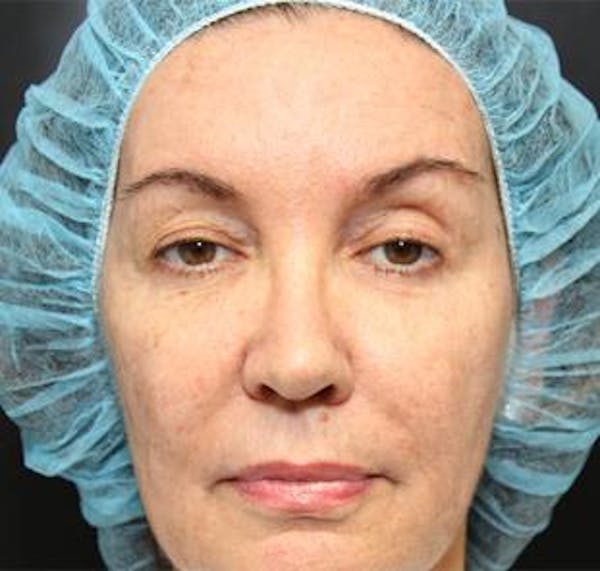  Blepharoplasty Before & After Gallery - Patient 25274659 - Image 1