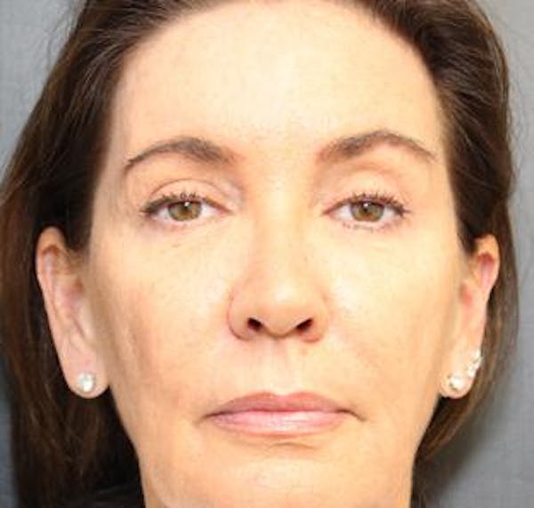  Blepharoplasty Before & After Gallery - Patient 25274659 - Image 2