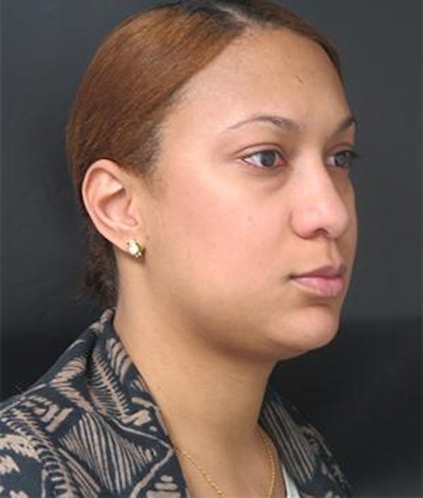  Blepharoplasty Before & After Gallery - Patient 25274660 - Image 1