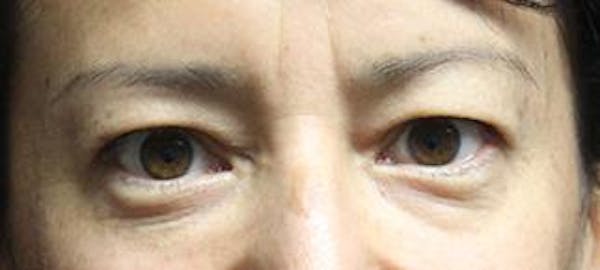  Blepharoplasty Before & After Gallery - Patient 25274661 - Image 1