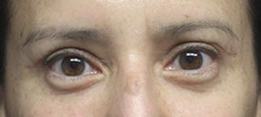  Blepharoplasty Before & After Gallery - Patient 25274661 - Image 2
