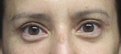  Blepharoplasty Before & After Gallery - Patient 25274661 - Image 2