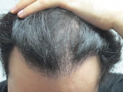 Hair Transplant Before & After Gallery - Patient 25274664 - Image 1