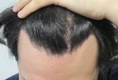 Hair Transplant Before & After Gallery - Patient 25274664 - Image 2