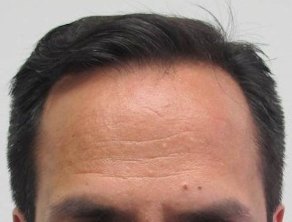Hair Transplant Before & After Gallery - Patient 25274665 - Image 1