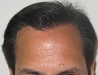Before and After Hair Transplantation in NYC