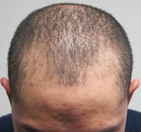 Hair Transplant Gallery - Patient 25274667 - Image 1