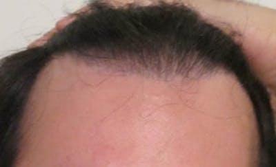 Hair Transplant Before & After Gallery - Patient 25274668 - Image 1