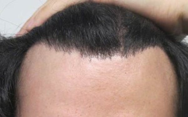 Hair Transplant Before & After Gallery - Patient 25274668 - Image 2