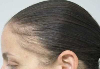 Hair Transplant Before & After Gallery - Patient 25274669 - Image 1