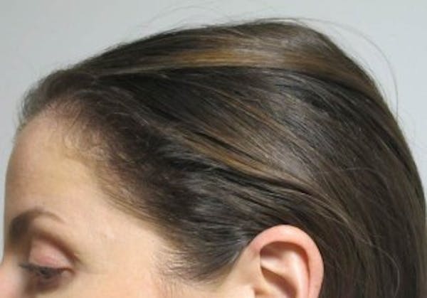 Hair Transplant Before & After Gallery - Patient 25274669 - Image 2