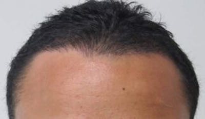 Hair Transplant Before & After Gallery - Patient 25274670 - Image 1