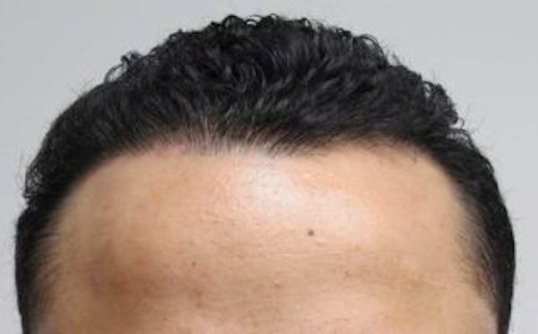 Hair Transplant Before & After Gallery - Patient 25274670 - Image 2