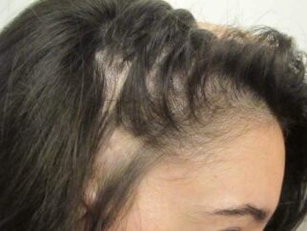 Hair Transplant Before & After Gallery - Patient 25274672 - Image 1