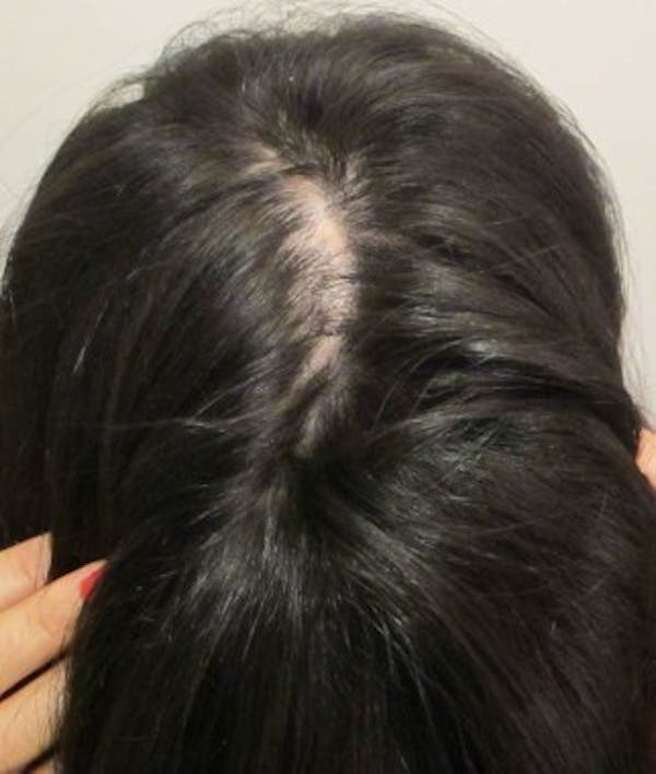 Hair Transplant Before & After Gallery - Patient 25274673 - Image 1