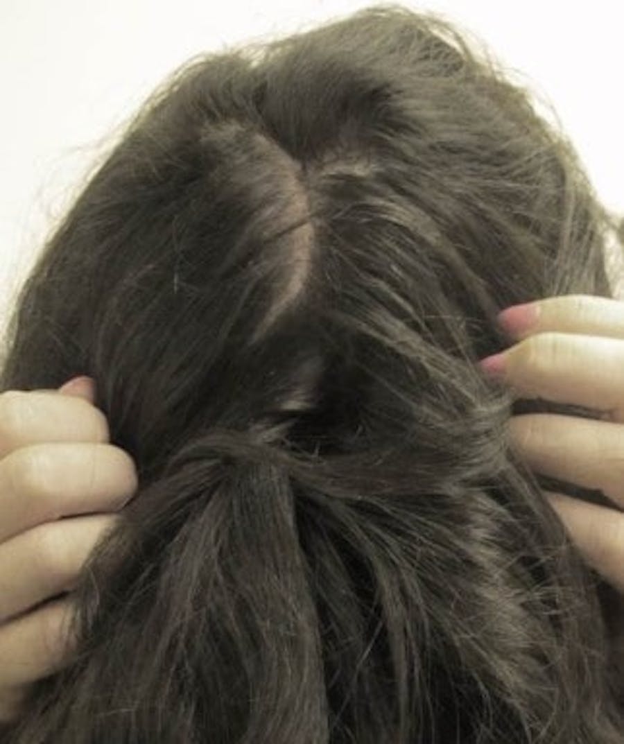 Hair Transplant Before & After Gallery - Patient 25274673 - Image 2