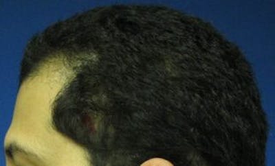 Hair Transplant Before & After Gallery - Patient 25274674 - Image 1