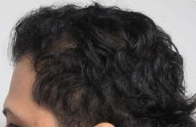 Hair Transplant Before & After Gallery - Patient 25274674 - Image 2