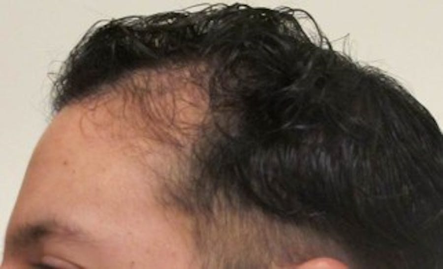 Hair Transplant Before & After Gallery - Patient 25274677 - Image 1