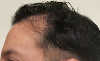Before and After Hair Restoration in NYC