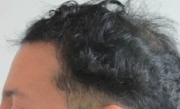 Hair Transplant Before & After Gallery - Patient 25274677 - Image 2