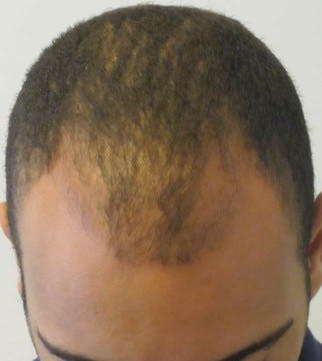 Before and after of a patient who received a hair transplant procedure