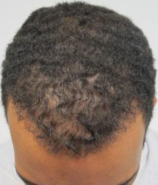 Before and after of a patient who received a hair transplant procedure
