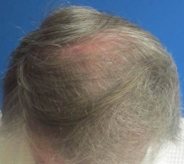 Hair Transplant Before & After Gallery - Patient 25274683 - Image 1