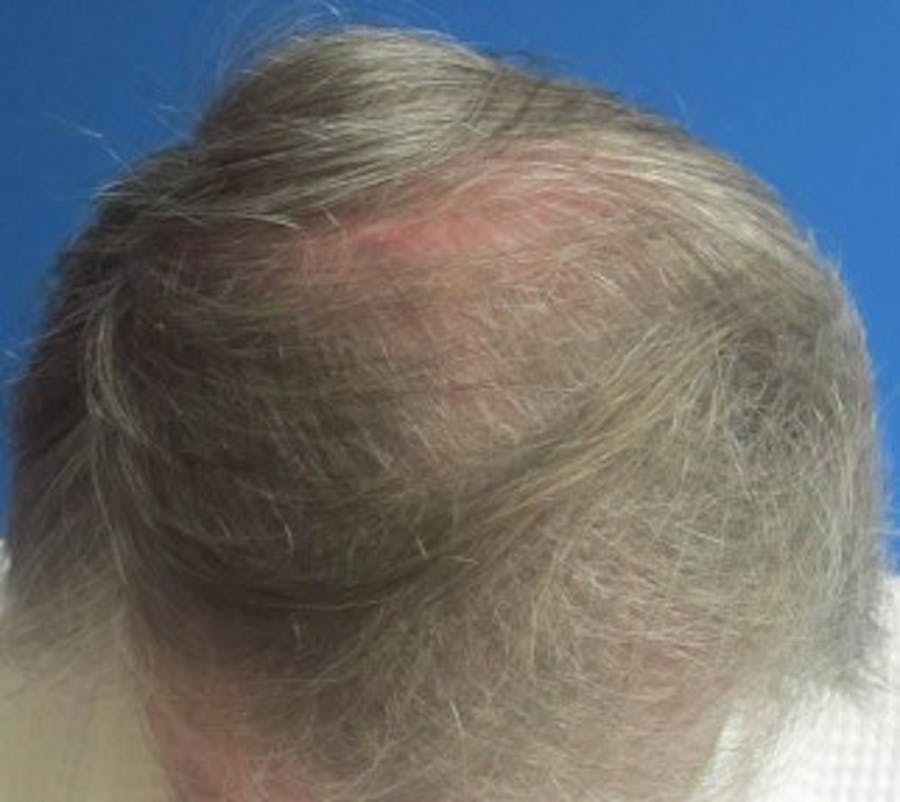 Hair Transplant Before & After Gallery - Patient 25274683 - Image 1
