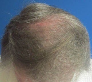 Before and after of a patient who received a hair transplant procedure