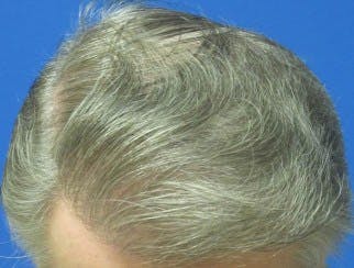 Before and after of a patient who received a hair transplant procedure