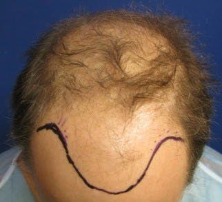 Before and after of a patient who received a hair transplant procedure