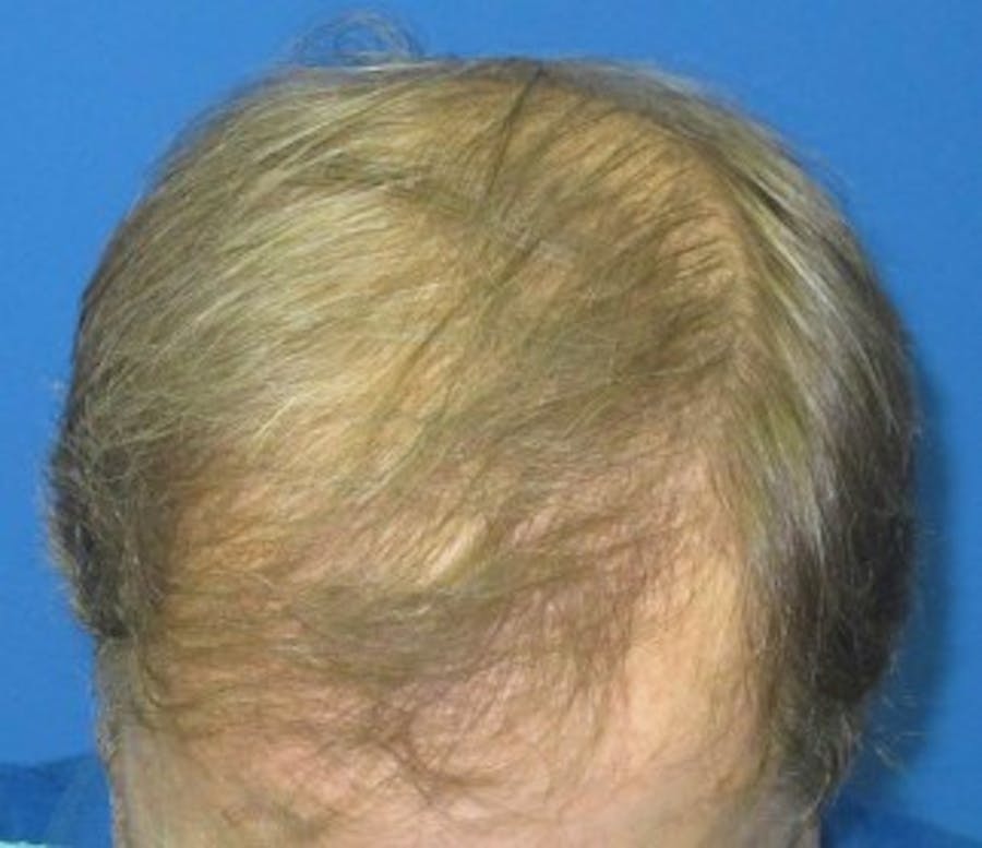 Hair Transplant Before & After Gallery - Patient 25274684 - Image 2
