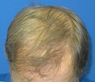 Before and after of a patient who received a hair transplant procedure