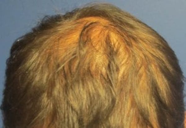 Hair Transplant Before & After Gallery - Patient 25274685 - Image 1