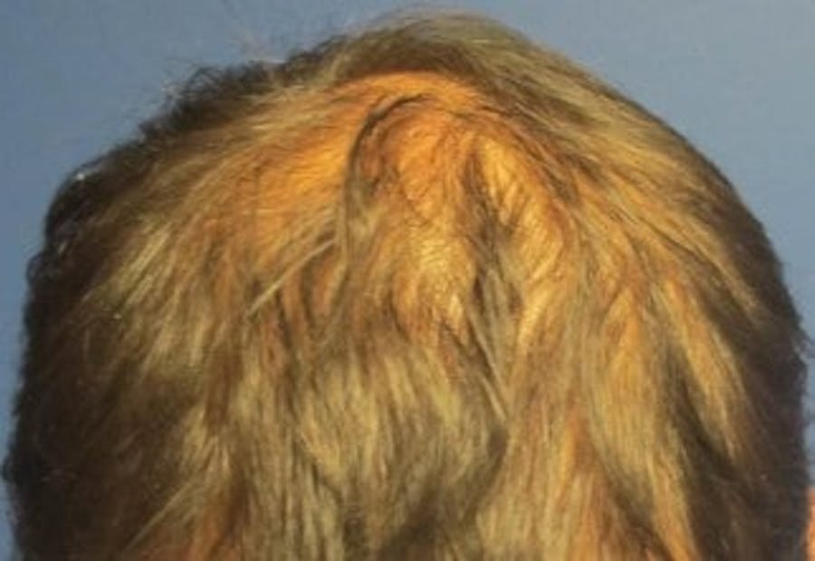 Hair Transplant Before & After Gallery - Patient 25274685 - Image 1
