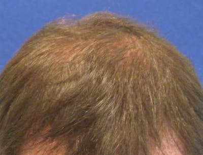 Hair Transplant Before & After Gallery - Patient 25274685 - Image 2