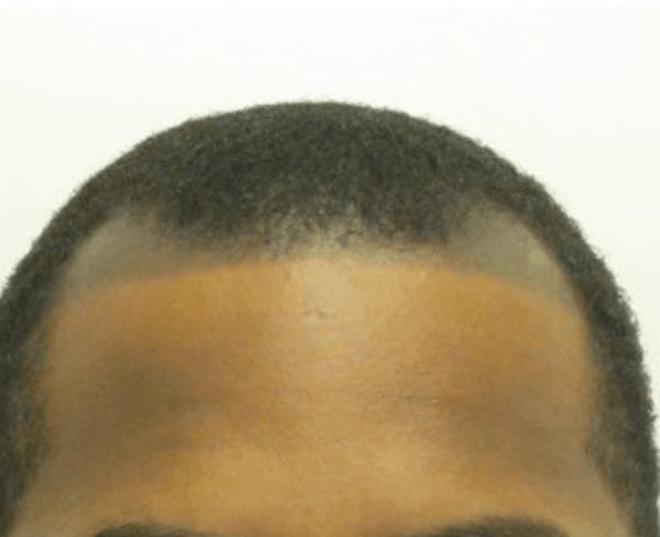 Hair Transplant Before & After Gallery - Patient 25274690 - Image 1